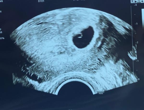 Bild zu Erster Ultraschall - Forum für März - Mamis