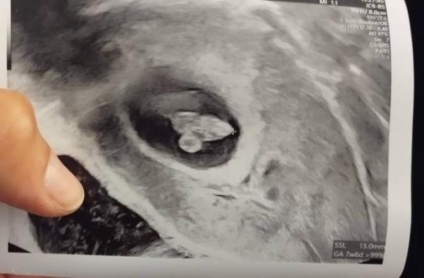 Bild zu Erster Ultraschall alles bestens - Forum für März - Mamis