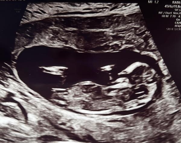 Bild zu Ersttrimester Screening Outing - Forum für März - Mamis