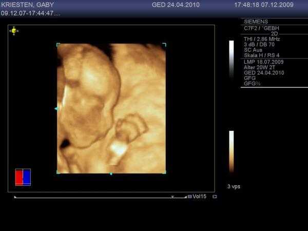 Bild zu Babybild von der Feindiagnostik... - Forum für April - Mamis