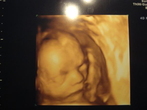 Bild zu Heute wieder VU + 3D-Bild - Forum für April - Mamis