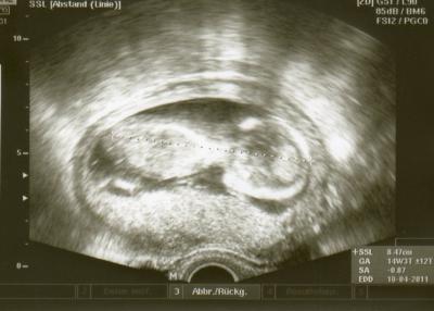 Bild zu VU und nix mit Outing:( + Anti D-Prophylaxe - Forum für April - Mamis
