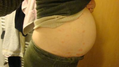 Bild zu Dermatitis - Forum für April - Mamis