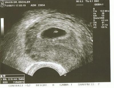 Bild zu Ultraschallbilder - Forum für April - Mamis