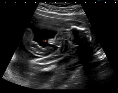 Bild zu zurück von der feindiagnostik - Forum für April - Mamis