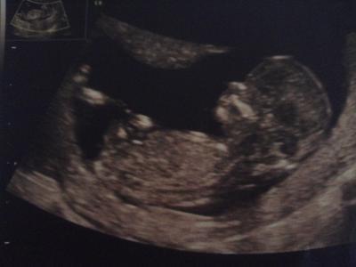 Bild zu Ersttrimesterscreening und vorsichtiges Outing - Forum für April - Mamis