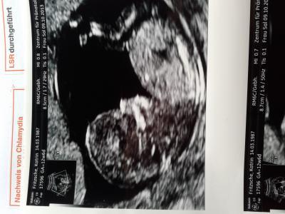 Bild zu Nackenfaltenmessung - Forum für April - Mamis