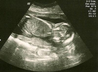 Bild zu FA-Bericht + Übelkeit wieder da - Forum für April - Mamis