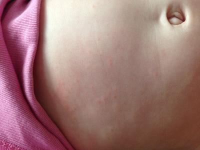 Bild zu Kleine rote Punkte - Forum für April - Mamis