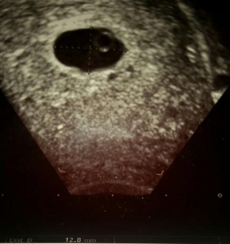 Bild zu Ultraschall - Forum für April - Mamis