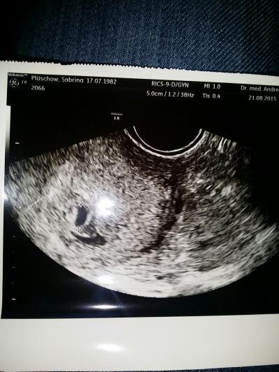Bild zu ANGST, Hämatom neben Fruchthöhle - Forum für April - Mamis