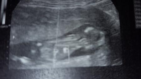 Bild zu 1. Großer Ultraschall/ Feindiagnostik 😍 - Forum für April - Mamis