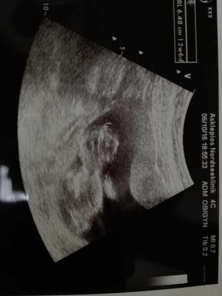 Bild zu Blutungen und Baby TV - Forum für April - Mamis