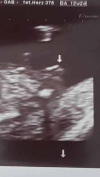 Bild zu Geschlecht erkennen... - Forum für April - Mamis