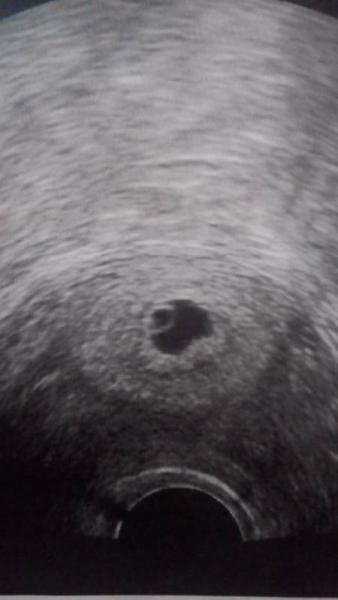 Bild zu Heute erster FA-Termin und Ultraschall - Forum für April - Mamis