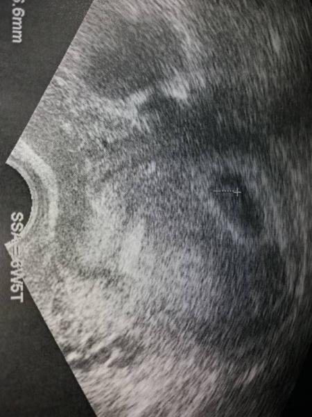 Bild zu Heute Ultraschall - Forum für April - Mamis