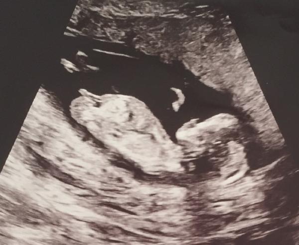 Bild zu Feindiagnostik - Forum für April - Mamis