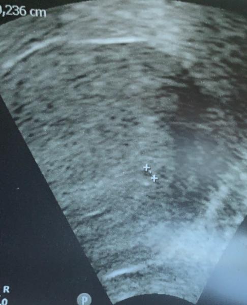 Bild zu Erste Ultraschall Untersuchung - Forum für April - Mamis