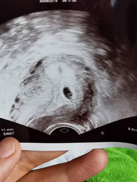 Bild zu 2 Fruchthöhlen? - Forum für April - Mamis