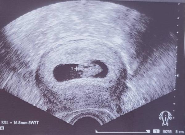 Bild zu Längliche Fruchthöle? - Forum für April - Mamis