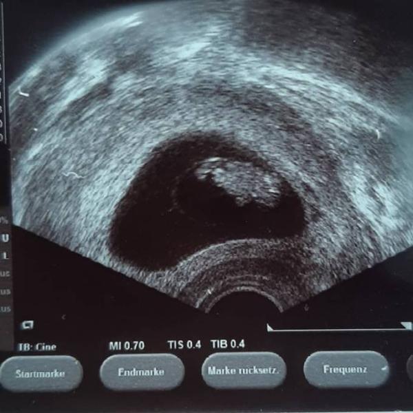 Bild zu Ultraschalltermin .. muss hier auch jemand Aspirin nehmen ? - Forum für April - Mamis