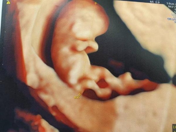 Bild zu Ultraschall ssw 9+6 - Forum für April - Mamis