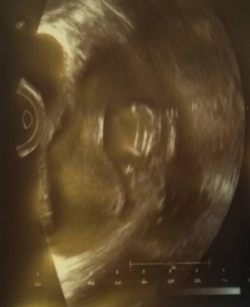 Bild zu Heute Termin bei 11+2 / Auflösung Schrödingers Baby - Forum für April - Mamis