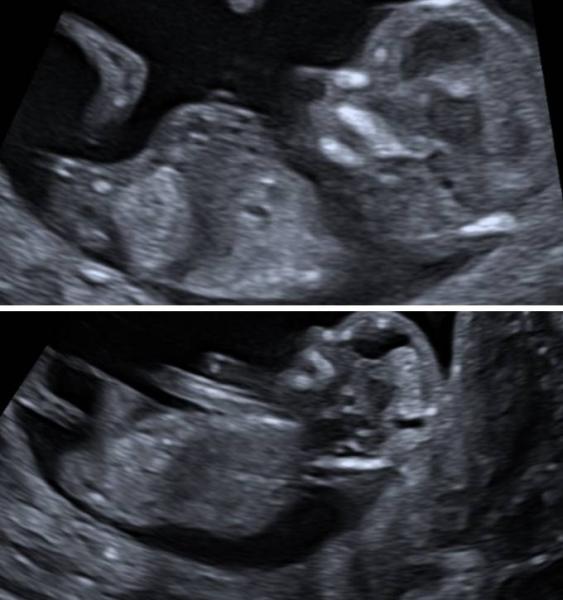 Bild zu Ersttrimester screening.. und (vorsichtiges) Outing - Forum für April - Mamis