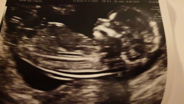 Bild zu Heute Ersttrimesterscreening - Forum für April - Mamis