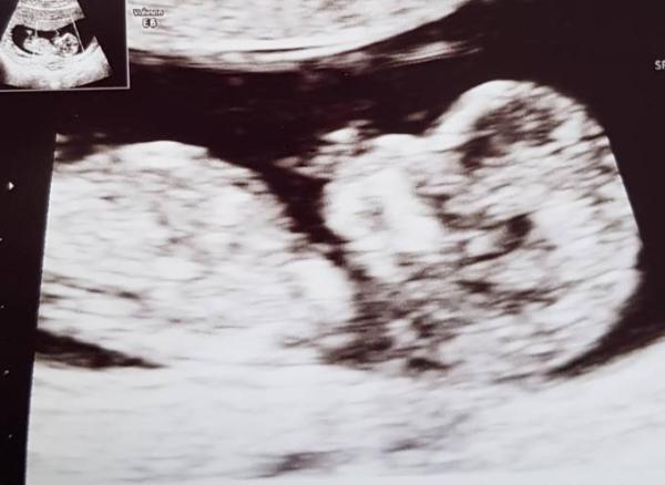 Bild zu Nackenfaltenmessung bestanden! - Forum für April - Mamis