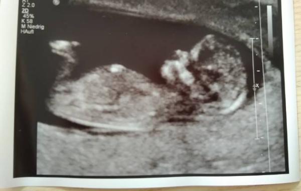 Bild zu Erstrrimesterscreening - Forum für April - Mamis