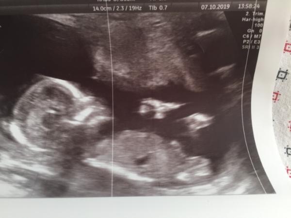 Bild zu OP geschafft - Forum für April - Mamis