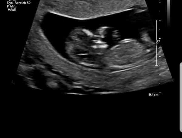 Bild zu Herzrasen - Forum für April - Mamis