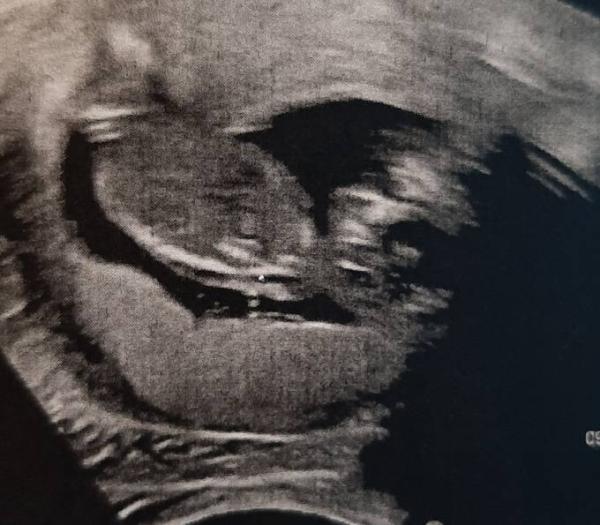 Bild zu Stumpfes Bauchtrauma - Forum für April - Mamis