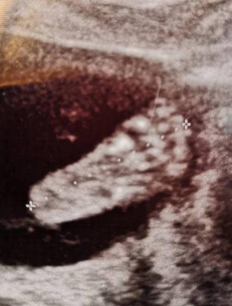Bild zu Heute Organscreening gehabt - Forum für April - Mamis
