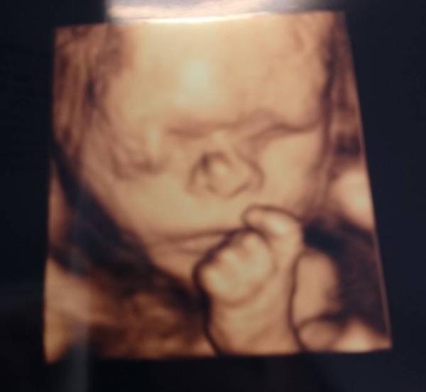 Bild zu Heute Feindiagnostik - Forum für April - Mamis