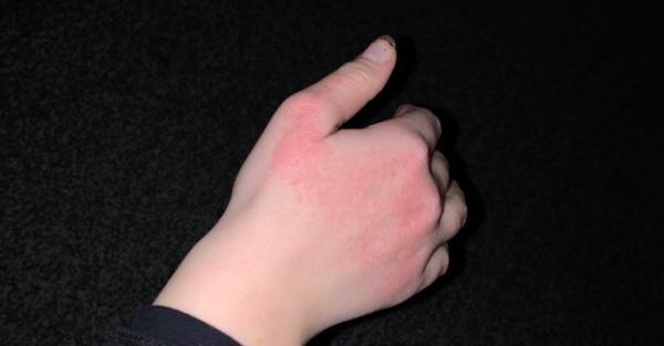 Bild zu Hand Mund Fuß - Forum für April - Mamis