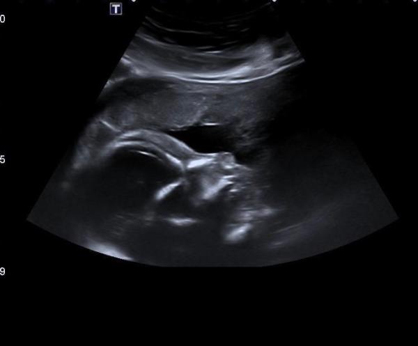 Bild zu Zurück von der Feindiagnostik.. - Forum für April - Mamis