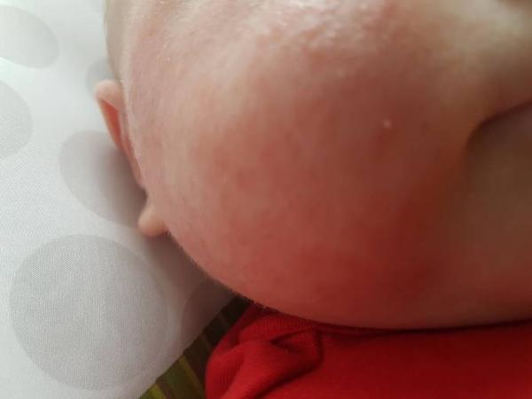 Bild zu gerötetes Gesicht - Forum für April - Mamis