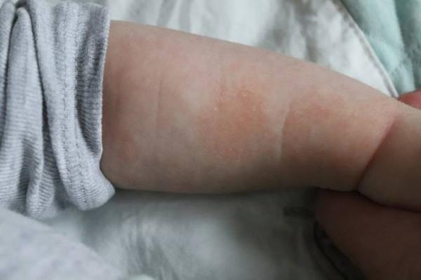 Bild zu Hauptproblem / trockene stellen - Forum für April - Mamis