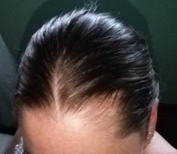 Bild zu Ach wie schön ist das....nicht! Haarausfall - Forum für April - Mamis