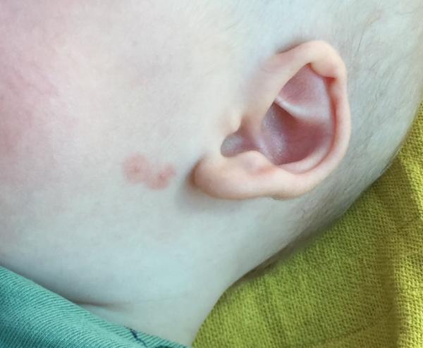 Bild zu Was sind das für Pusteln? - Forum für April - Mamis