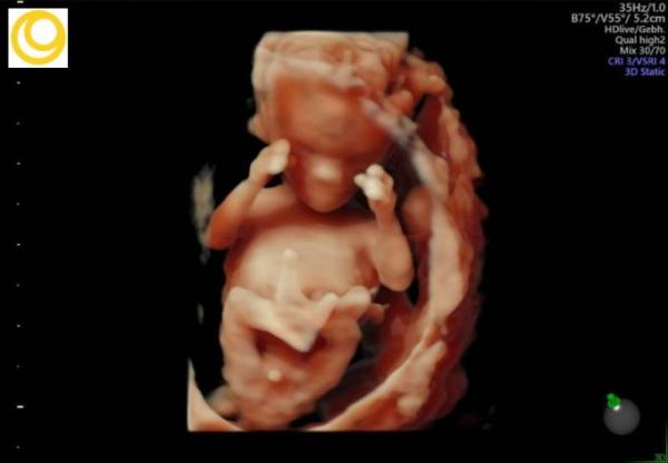 Bild zu Feinultraschall - Forum für April - Mamis