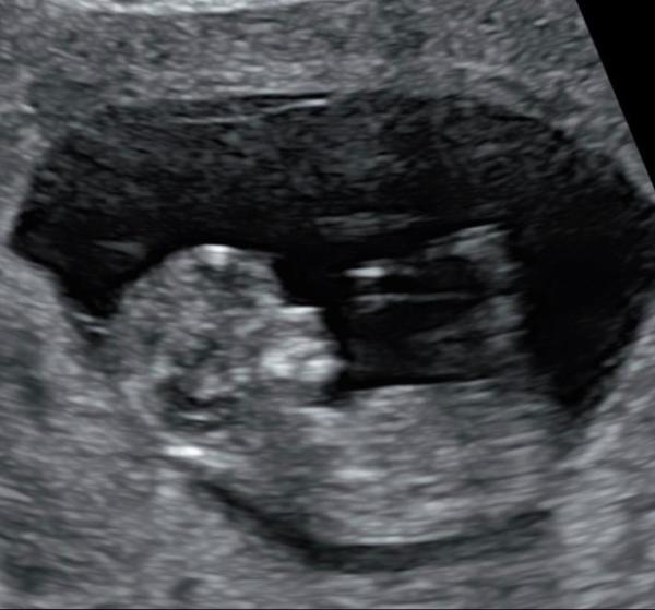 Bild zu Zurück vom ersten Screening - Forum für April - Mamis