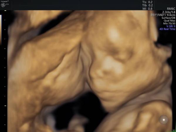 Bild zu Feinultraschall Herz ♥ - Forum für April - Mamis