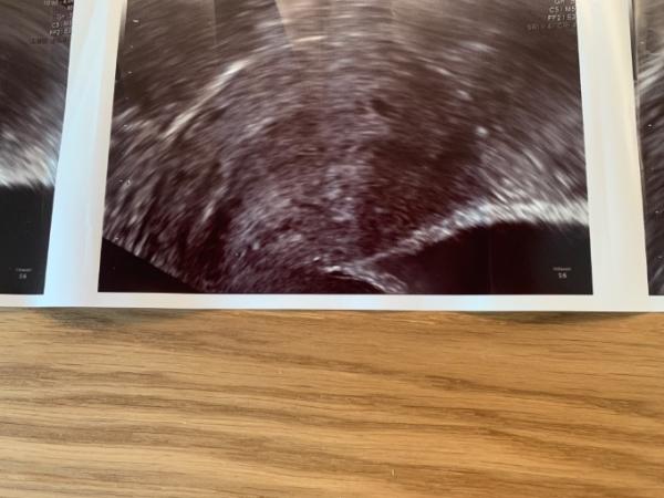 Bild zu Hilfe! SSW 5+1 - Forum für April - Mamis