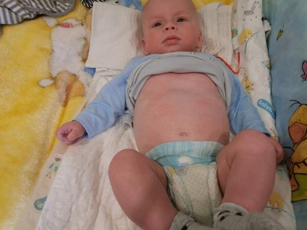 Bild zu Rote flecken auf bauch und brust - Forum für April - Mamis