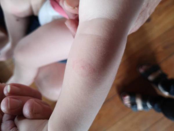 Bild zu Borreliose durch Stechmücken?! - Forum für April - Mamis