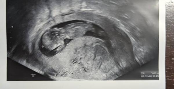 Bild zu NIPT Test gestern erledigt und abgehakt 🍀🍀🍀🍀 - Forum für April - Mamis