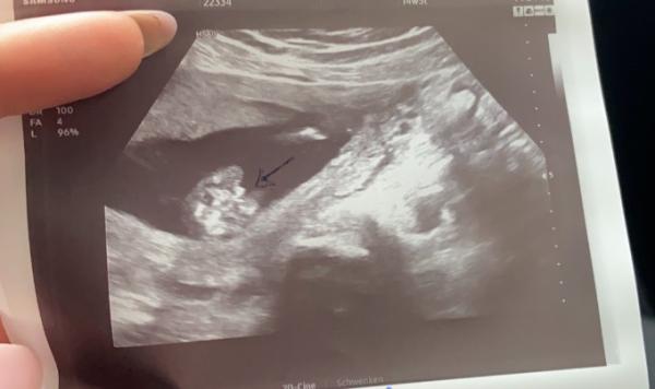 Bild zu 2 Ärzte, 2 verschiedene Outings 14+5ssw - Forum für April - Mamis